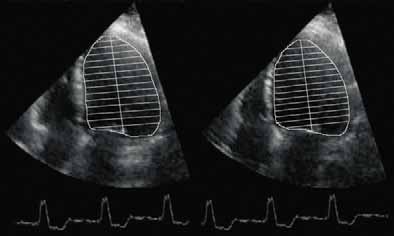 Obrázek 3. Apikální čtyřdutinová projekce před implantací biventrikulárního kardiostimulátoru u pacientky č. 1. Na levé části obrázku je zachycena end-diastola a vpravo end-systola levé komory.