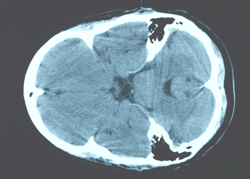 Pomocná vyšetření zobrazovací metody CT, MRI, SPECT (?), likvor Fyzikální vyš., laboratorní vyš., neurologické vyš., EEG.