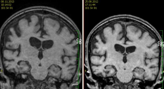 Během roku do září 2013 postupná rychlá progrese poruchy kognice, zhoršení orientace v čase i v prostoru, výrazné