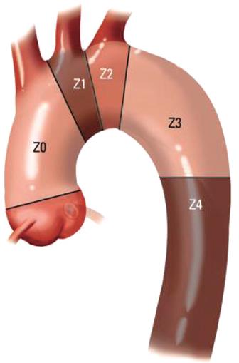 Indikace TEVAR, proximální kotvící zóny Aneurysmata