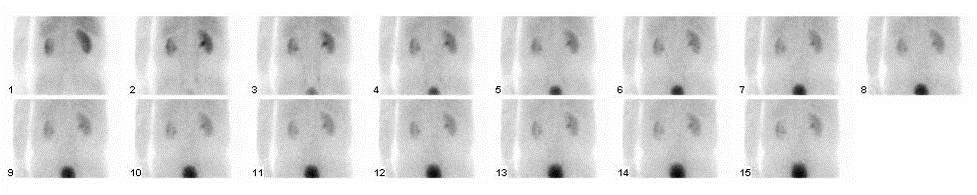 Obr. Statická scintigrafia obličiek- SPECT, hore normálny, dole patologický nález Indikácie Afunkcia alebo chýbanie jednej z obličiek Zistenie lézie parenchýmu po akútnej pyelonefritíde, po úraze