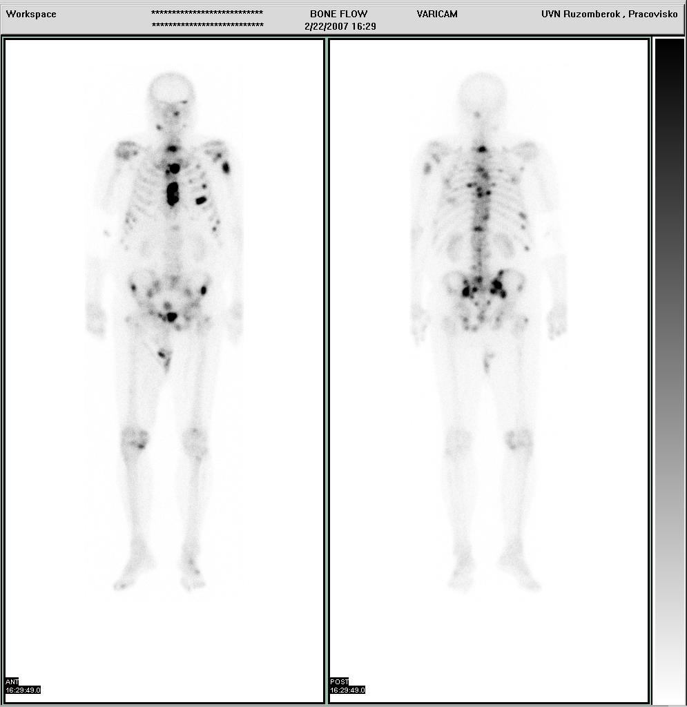 Obr. Scintigrafia skeletu, vľavo normálny nález,vpravo mnohopočetné metastázy v skelete Trojfázová scintigrafia skeletu (3FS) Vyšetrenie sa robí v ľahu s nastavením záujmovej oblasti s podozrením na