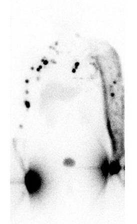 Rádionuklidová lymfografia pomocou 99mTc Nanocoll detekcia lymfatického systému, predovšetkým na dolných končatinách. Obr.č. 10 Lymfografia, vľavo negatívny nález ostatné nálezy sú pozitívne.