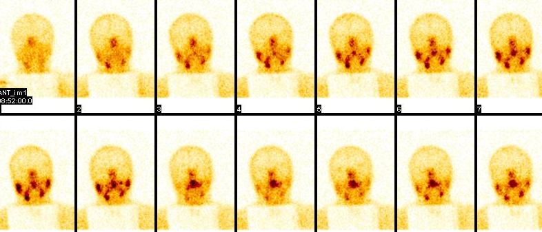Dynamická scintigrafia slinných žliaz Parenchým má možnosť akumulovať 99 mtc a umožňuje tak zobraziť párové slinné žľazy (gl. parotis, gl.