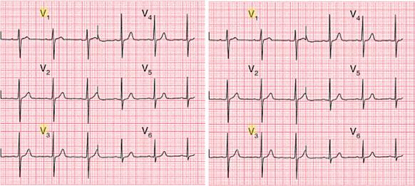 Obr. 1. 3: EKG signál jednotlivých končetinových a hrudních svodů, převzato z [2] 1.