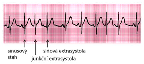 komorové. Síňové extrasystoly se na EKG projeví dříve přicházející vlnou P, interval PQ může být zkrácen, nachází li se ektopické místo se ektopické místo v blízkosti atrioventrikulárního uzlu.