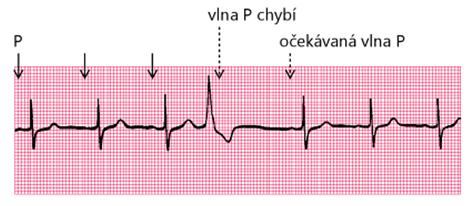 retrográdně AV uzlem. Vzdálenosti kmitů R generovaných SA uzlem proto nebývají komorovými extrasystolami změněny.