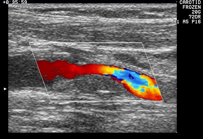 Příloha č. 3 Barevný Doppler stenóza a.