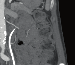 Metodami zobrazení křížících cév jsou klasická angiografie, spirální CT angiografie, ultrazvuk a barevné dopplerovské mapování, endoluminální ultrazvuk a MR.