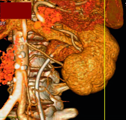 Obr. 7: CT spirální angiografie, 3D rekonstrukce křížící cévy a pánvičky ledvinné Spirální CT angiografie s vysokou přesností detekuje přítomnost cévní struktury a obvykle i vztah cévy k vývodným