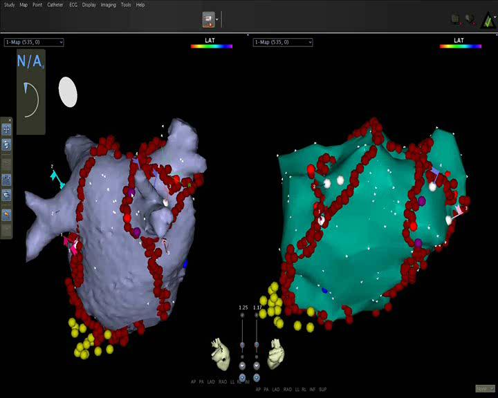 Zobrazení katetrů 3D-elektroanatomické mapování