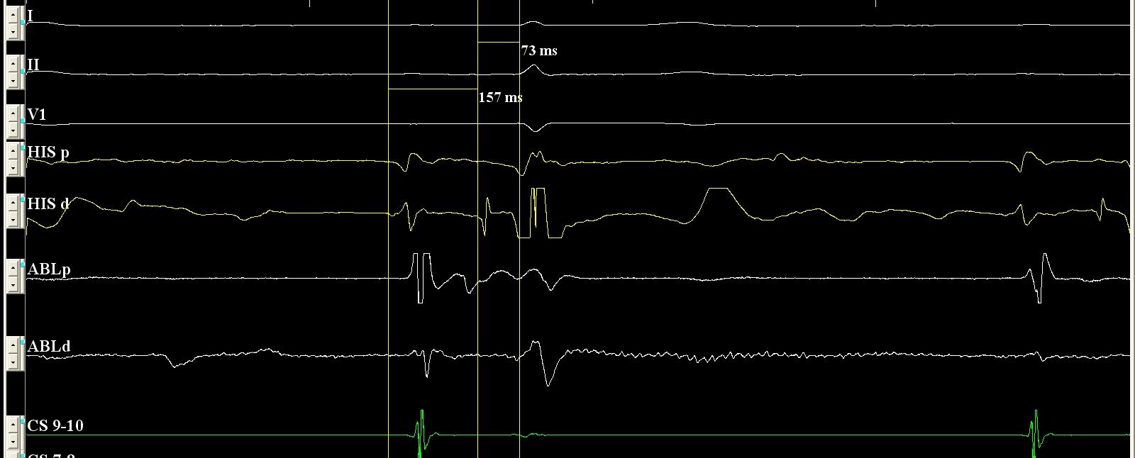 Základní elektrofyziogické parametry Hisogram AH (50-120ms) vedení v AV uzlu Prodloužení: postižení AV uzlu, užívání antiarytmik Zkrácení: katecholaminy HV (35-55ms)