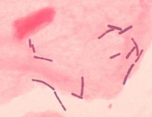 symptomem bakteriální vaginózy, mnoho takto postižených žen je však asymptomatických (Klebanoff et al., 2004). Bakteriální vaginóza se obvykle léčí metronidazolem či klindamycinem (Homayouni et al.