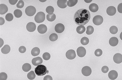 Hypochromní microcytární anémie Anémie z nedostatku železa Megaloblastové anémie Perniciózní anémie perniciózní anémie - nedostatek produkce vnitřního faktoru v žaludku vst