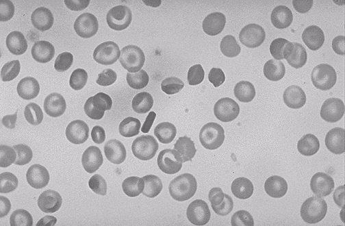 Aplastické anémie útlum tvorby Ery v kostní dřeni pancytopenie i ostatních krevních buněk vrozená Fanconiho anémie získané - celotělové ozáření - léky a chemikálie (cytostatika) - infekční nemoci -