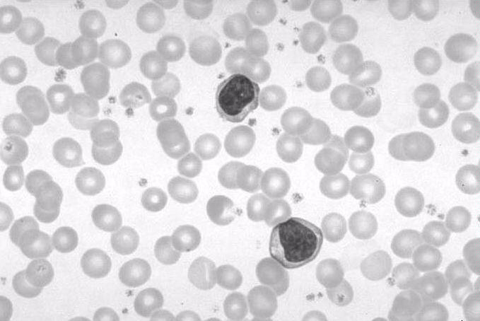 Trombocyty úlomky buněk (megakaryocytů( megakaryocytů), bez jádra fce: : zástava krvácení (primární hemostáza), imunita životnost v krvi 8 108 dnů trombocytopenie (x trombocytopatie = porucha funkce)