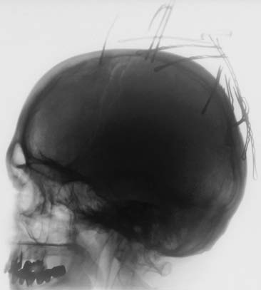 12 Základní principy RTG diagnostiky Magnetická rezonance (MR) Magnetická rezonance se v současnosti uplatňuje v diagnostice některých zlomenin (stresové zlomeniny), poranění šlach, svalů