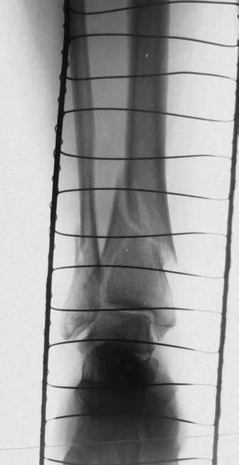 18 Obecná traumatologie skeletu 2 Obr. 2.1 Jednoduchá příčná zlomenina tibie, typ A podle AO klasifikace. Současně je přítomná nedislokovaná nitrokloubní zlomenina proximální části Obr. 2.2 Spirální zlomenina distální části tibie a šikmá zlomenina zevního kotníku.
