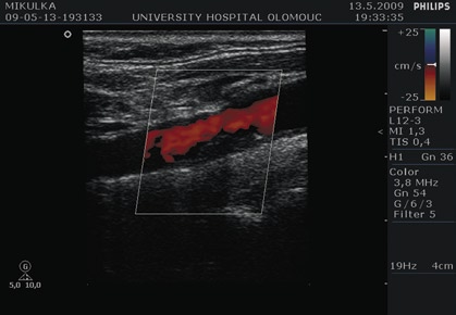 Akutní fáze ischemické cévní mozkové příhody diagnostika 1 Nicméně z praktického hlediska má použití PWI v klinické praxi několik limitací, z nichž asi nejdůležitější je fakt, že dosud nepanuje shoda