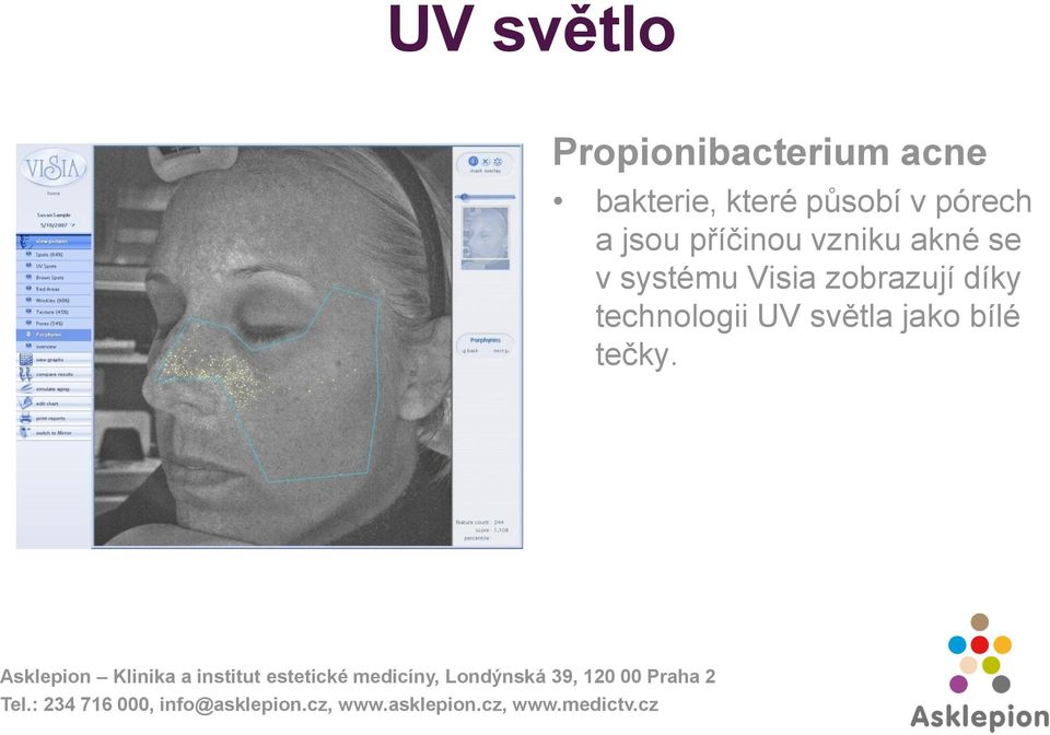 příčinou vzniku akné se v systému Visia