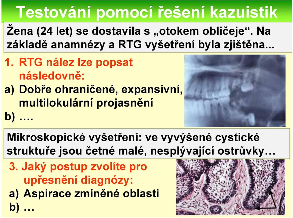 RTG nález lze popsat následovně: a) Dobře ohraničené, expansivní, multilokulární projasnění b).