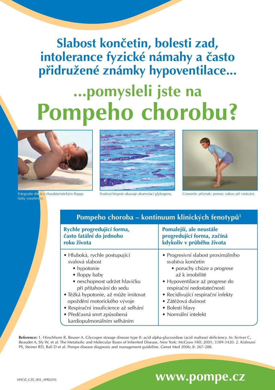 Pompeho choroba kontinuum klinických fenotypů Rychle progredující forma, často fatální do jednoho roku života Hluboká, rychle postupující svalová slabost hypotonie floppy baby neschopnost udržet