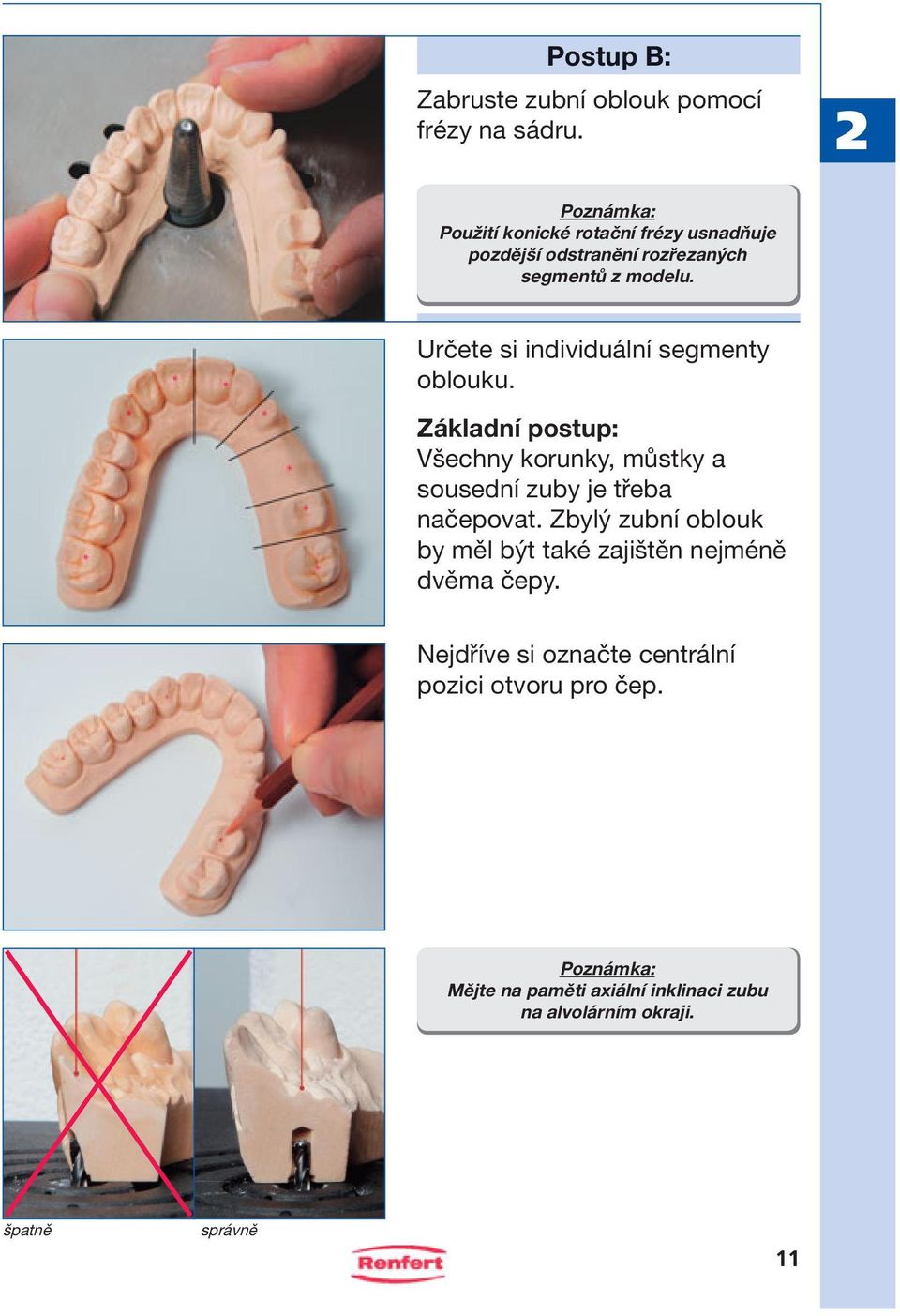 Určete si individuální segmenty oblouku. Základní postup: Všechny korunky, můstky a sousední zuby je třeba načepovat.