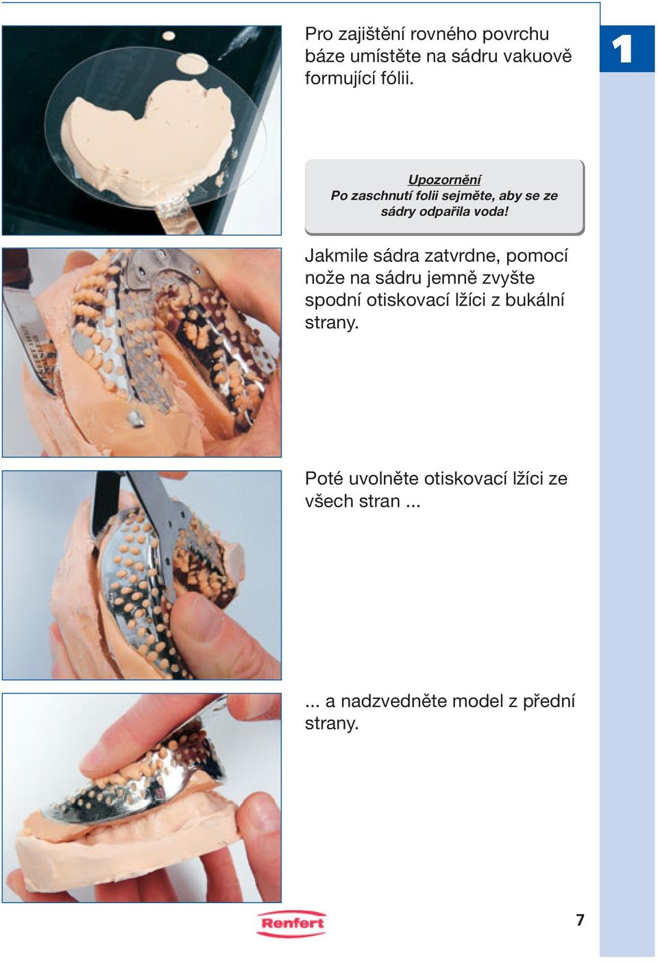 Jakmile sádra zatvrdne, pomocí nože na sádru jemně zvyšte spodní otiskovací lžíci z