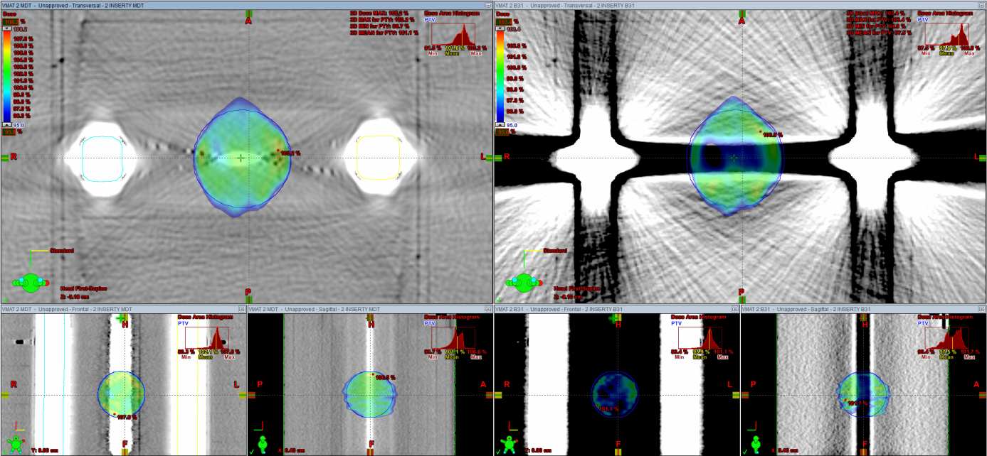 Obrázek 11 - Snímek ozařovacích plánů pro cílový objem umístěný mezi kovovými inserty 3.