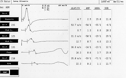 Elektrodiagnostika: multifokální