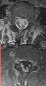 CIDP: diagnostika MR: enhancement v oblasti kaudy a kořenů svědčících pro