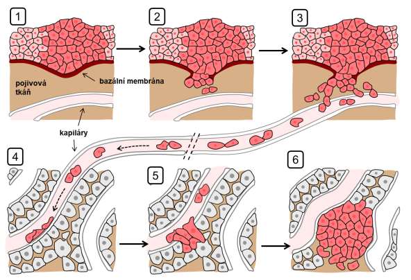 Obr. 10.2. Schéma jednotlivých fází vzniku metastáz z původního mateřského nádoru. 1) Nádorové buňky rostou jako nezhoubná tkáň v epitelu.