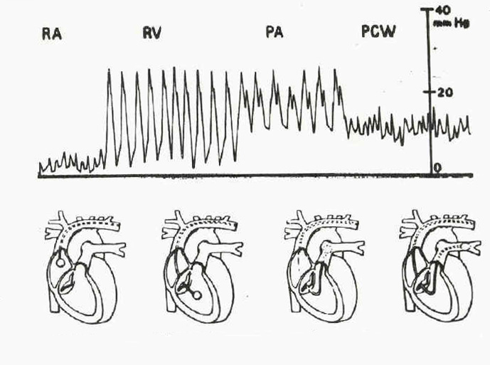 Měření DO 2 a VO 2 Pomocí Fickova principu PA katetr Výhody komplexní hemodynamický profil (CO, SV,