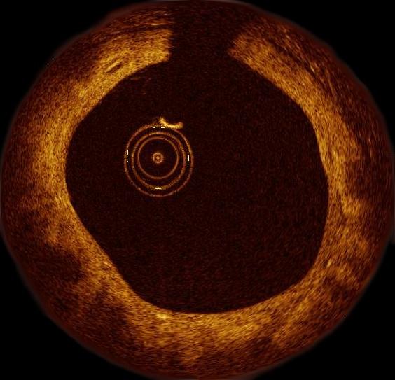 Biodegradabilní stenty Absorb Trial - OCT : Complete