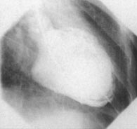 Klinická krdiologie (orzový text) A A 54. Angiogrm levé komory v prvé přední šikmé projekci ukzuje v () systolickém () distolickém rámečku gloální hypokinezu diltci levé komory.
