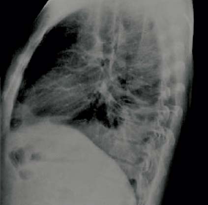 Kazuistiky Obr. 8 Pravoboční skiagram hrudníku čtvrtého pacienta před zahájením léčby erlotinibem a v průběhu terapie. 500 mg/m 2 v období 4 5/2008.