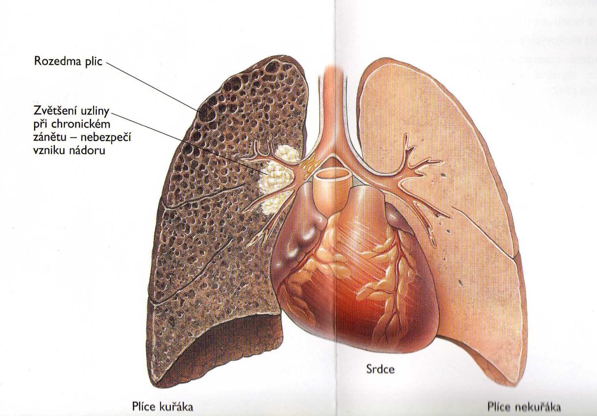 Obrázek číslo 1: Plíce kuřáka a nekuřáka Zdroj: