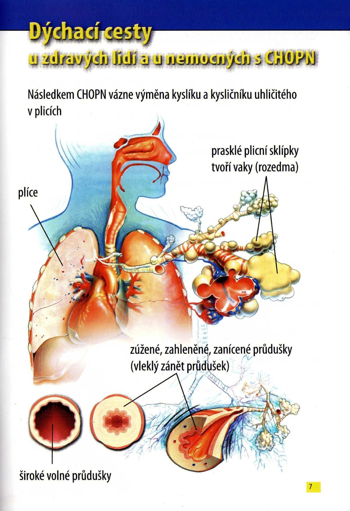 Obrázek číslo 2: Dýchací cesty u zdravých lidí a u nemocných s