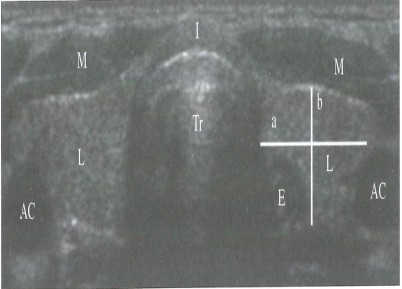 2.4.3. Zobrazovací metody V diagnostice poruch funkce štítné ţlázy se vyuţívají metody ultrazvukového vyšetření, biopsie a scintigrafie.