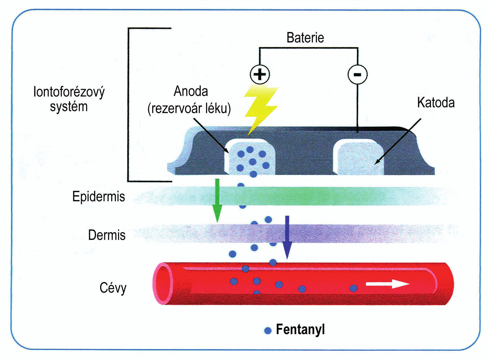 Obrázek 3. Schematické zobrazení systému iontoforézy pro podávání fentanylu trvající bolesti.