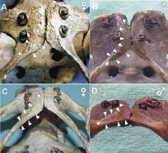 Obrázek 1. Nervus dorsalis penis a nervus dorsalis clitoridis. Obrázek 2. Sulcus nervi dorsalis penis/clitoridis na os pubis. A. Sulcus nervi dorsalis clitoridis (špičky šipek) z ventrálního pohledu.