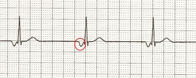 SINOATRIÁLNÍ BLOKÁDA II. STUPNĚ: Má dva podtypy: I. typ - Wenckebachovy periody zkracuje se interval mezi vlnami P, až nakonec dochází k výpadku P vlny i QRS komplexu. Obr. 6 SA blok II.