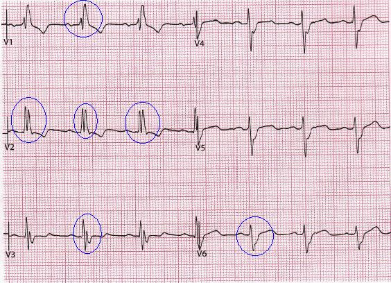 Obr. 13 Blokáda pravého Tawarova raménka [BENNETT, 2014] BLOKÁDA LEVÉHO TAWAROVA RAMÉNKA, LBBB (LEFT BUNDLE BRANCH BLOCK): Neúplnou a úplnou blokádu charakterizujeme stejně jako blokádu pravého