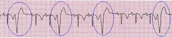 2.8.6 Ventrikulární extrasystoly Komorové extrasystoly jsou na EKG záznamu typicky charakterizovány prodlouženým QRS komplexem, nad 0,12 s, a mají abnormální tvar (viz obr. 20).