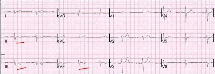 Obr. 27 Akutní infarkt myokardu s ST elevacemi [kardioblogie.blogspot.cz, 18] 2.9.2 Infarkt myokardu bez ST elevací (NON STEMI) Pokud infarkt nezasáhne celou šířku srdeční stěny a nevytvoří tzv.