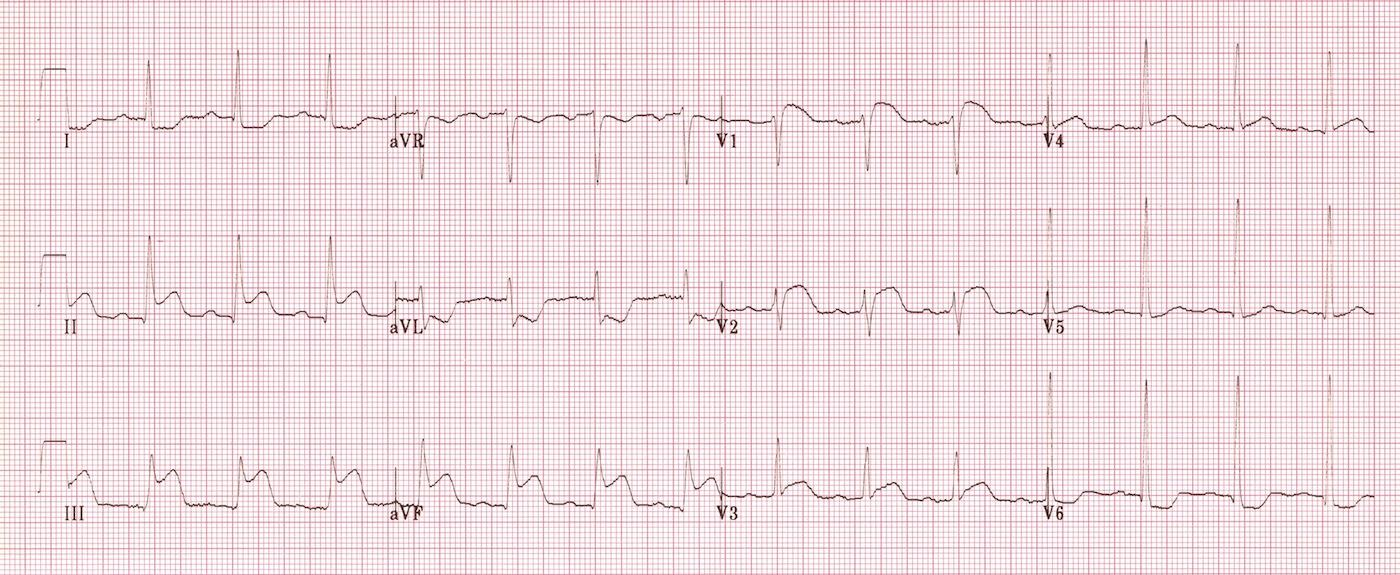 5. Co představuje tato křivka na EKG záznamu? a) Komorová tachykardie b) Bezpulzová elektrická aktivita (PEA) c) Komorová fibrilace d) Torsade de pointes 6. Co představuje tento EKG záznam?