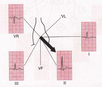 Příloha 11: Srdeční osa Zdroj: HAMPTON, John R. EKG v praxi: překlad 4.