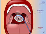Příloha N Nepřímá laryngoskopie Obr.