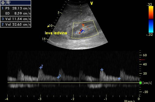 Systémová a renální hemodynamika Validní vyšetření u 95-96% ventilovaných pacientů Pohyb ledviny s ventilací (RR: významnější vliv