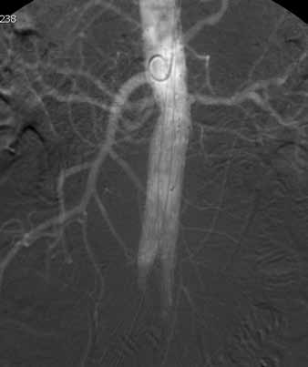 Obr. 1A Obr. 1B Obr. 1C Obr. 1. Čtyřiasedmdesátiletý muž s juxtarenálním aneuryzmatem abdominální aorty indikován k implantaci fenestrovaného stentgraftu.